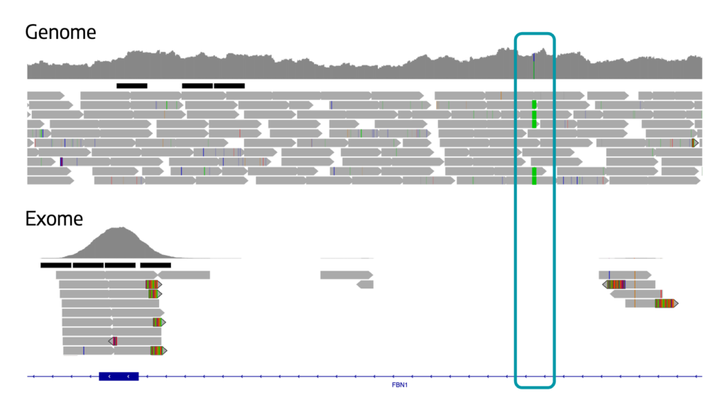IGV view of FBN1 variant